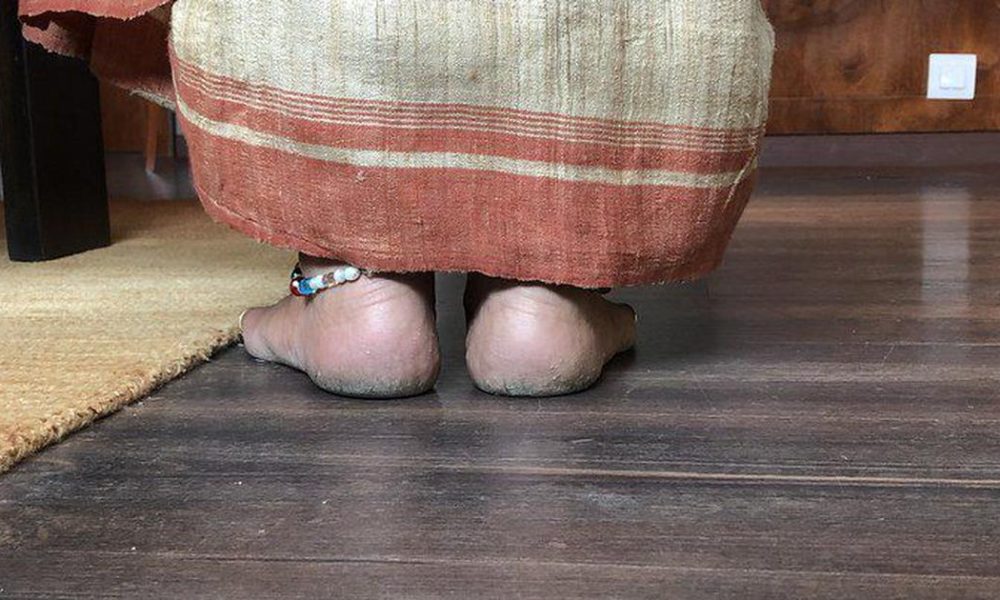 Krack Cream Revolutionizes Foot Care by Addressing a Common Yet Overlooked Issue for Women