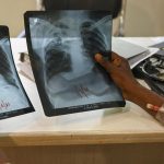 Lessons from Lakshadweep: A Model for TB Elimination in India
