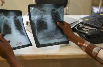 Lessons from Lakshadweep: A Model for TB Elimination in India