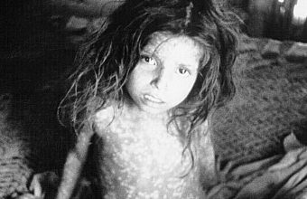 Colonial India and Smallpox: A Challenge to Britain’s Perceived Superiority