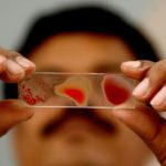 India Lacks Data on Anemia Among Women and Children for the First Time in 30 Years