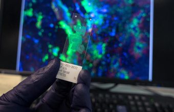 New WHO Study Reveals Infection-Linked Cancer Cases Could Reach 12% Globally in 2024