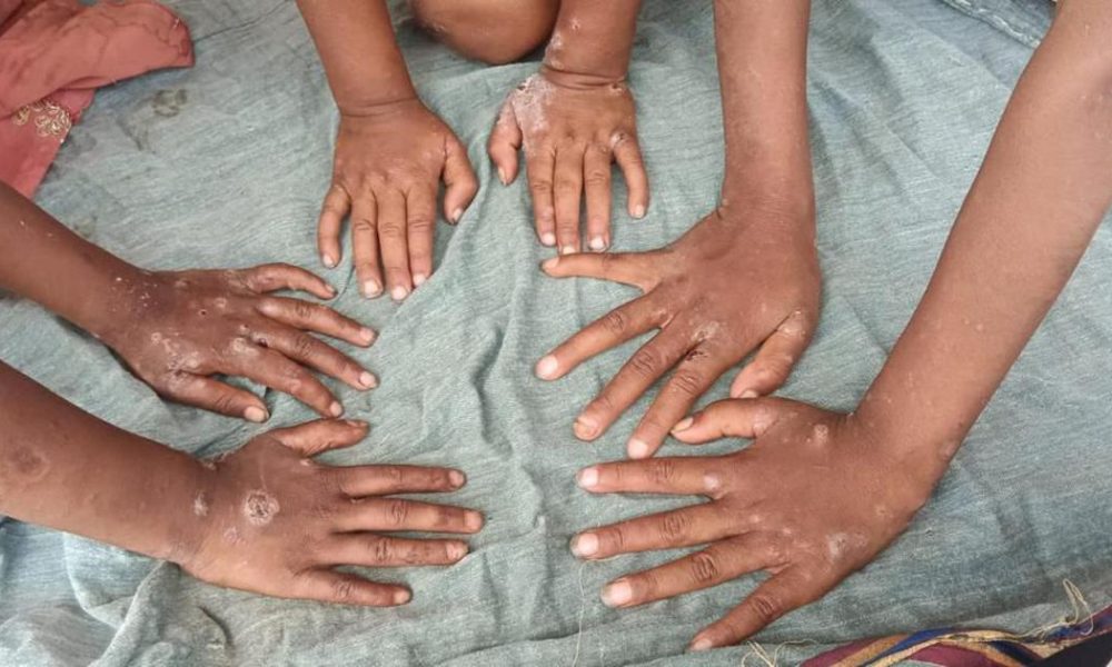 Scabies: The Hidden Epidemic Plaguing India's Vulnerable Communities