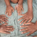 Scabies: The Hidden Epidemic Plaguing India's Vulnerable Communities