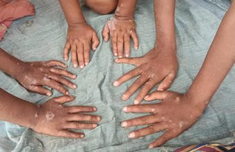 Scabies: The Hidden Epidemic Plaguing India's Vulnerable Communities
